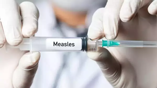 Is Measles Contagious in 2025