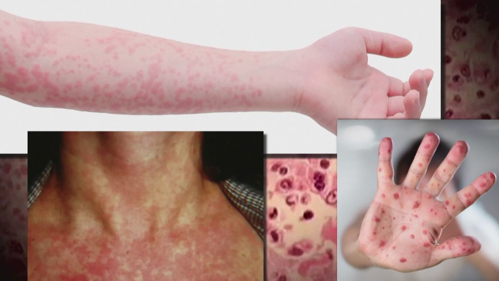 Is Measles Contagious in 2025